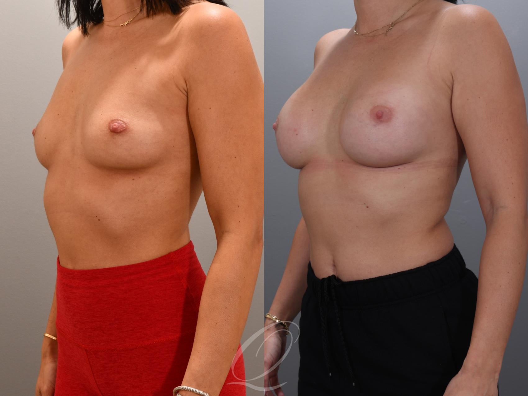 Breast Augmentation Case 1001931 Before & After Left Oblique | Serving Rochester, Syracuse & Buffalo, NY | Quatela Center for Plastic Surgery