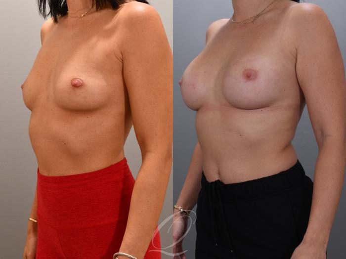 Breast Augmentation Case 1001931 Before & After Left Oblique | Serving Rochester, Syracuse & Buffalo, NY | Quatela Center for Plastic Surgery