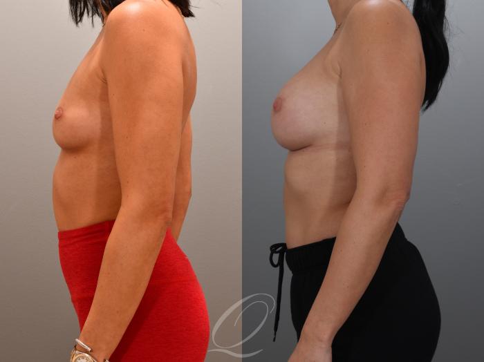 Breast Augmentation Case 1001931 Before & After Left Side | Serving Rochester, Syracuse & Buffalo, NY | Quatela Center for Plastic Surgery