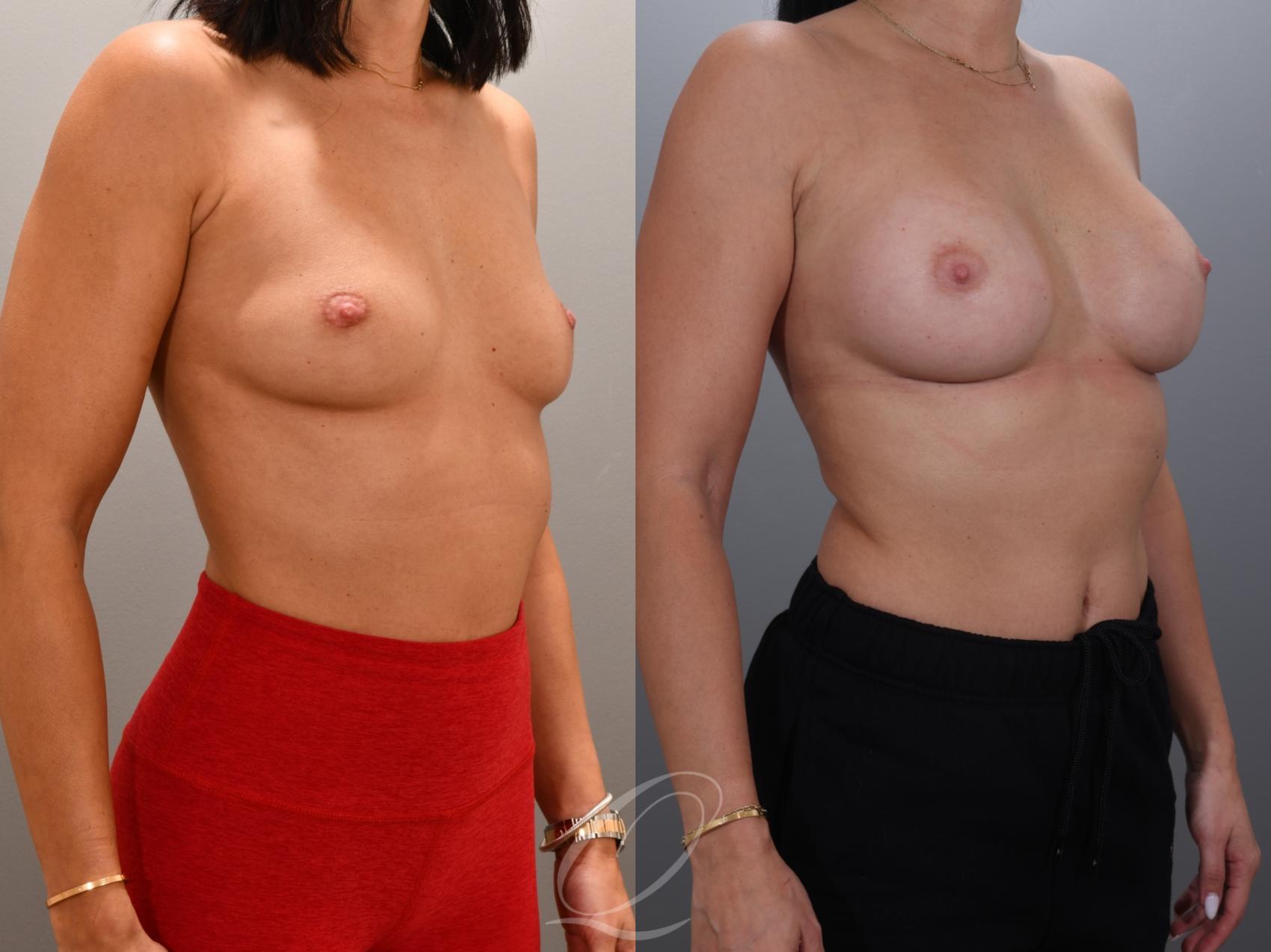 Breast Augmentation Case 1001931 Before & After Right Oblique | Serving Rochester, Syracuse & Buffalo, NY | Quatela Center for Plastic Surgery