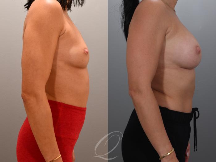 Breast Augmentation Case 1001931 Before & After Right Side | Serving Rochester, Syracuse & Buffalo, NY | Quatela Center for Plastic Surgery