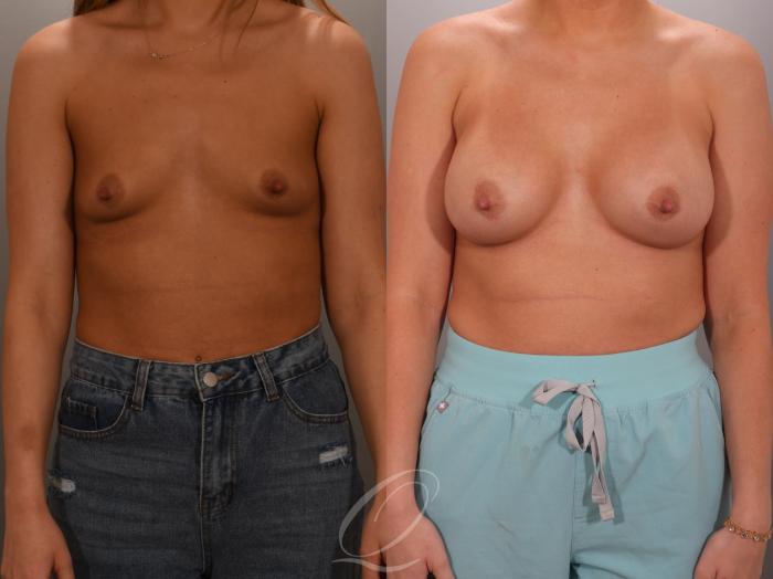 Breast Augmentation Case 1001936 Before & After Front | Serving Rochester, Syracuse & Buffalo, NY | Quatela Center for Plastic Surgery
