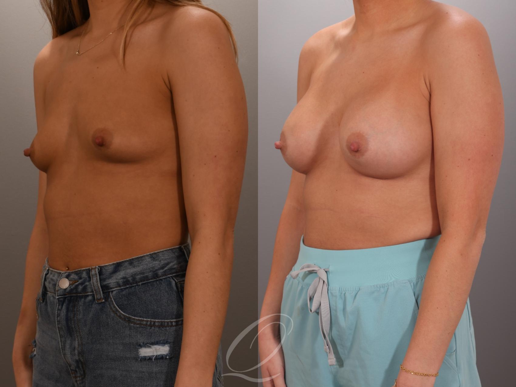 Breast Augmentation Case 1001936 Before & After Left Oblique | Serving Rochester, Syracuse & Buffalo, NY | Quatela Center for Plastic Surgery