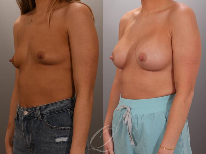 Breast Augmentation Case 1001936 Before & After Left Oblique | Serving Rochester, Syracuse & Buffalo, NY | Quatela Center for Plastic Surgery