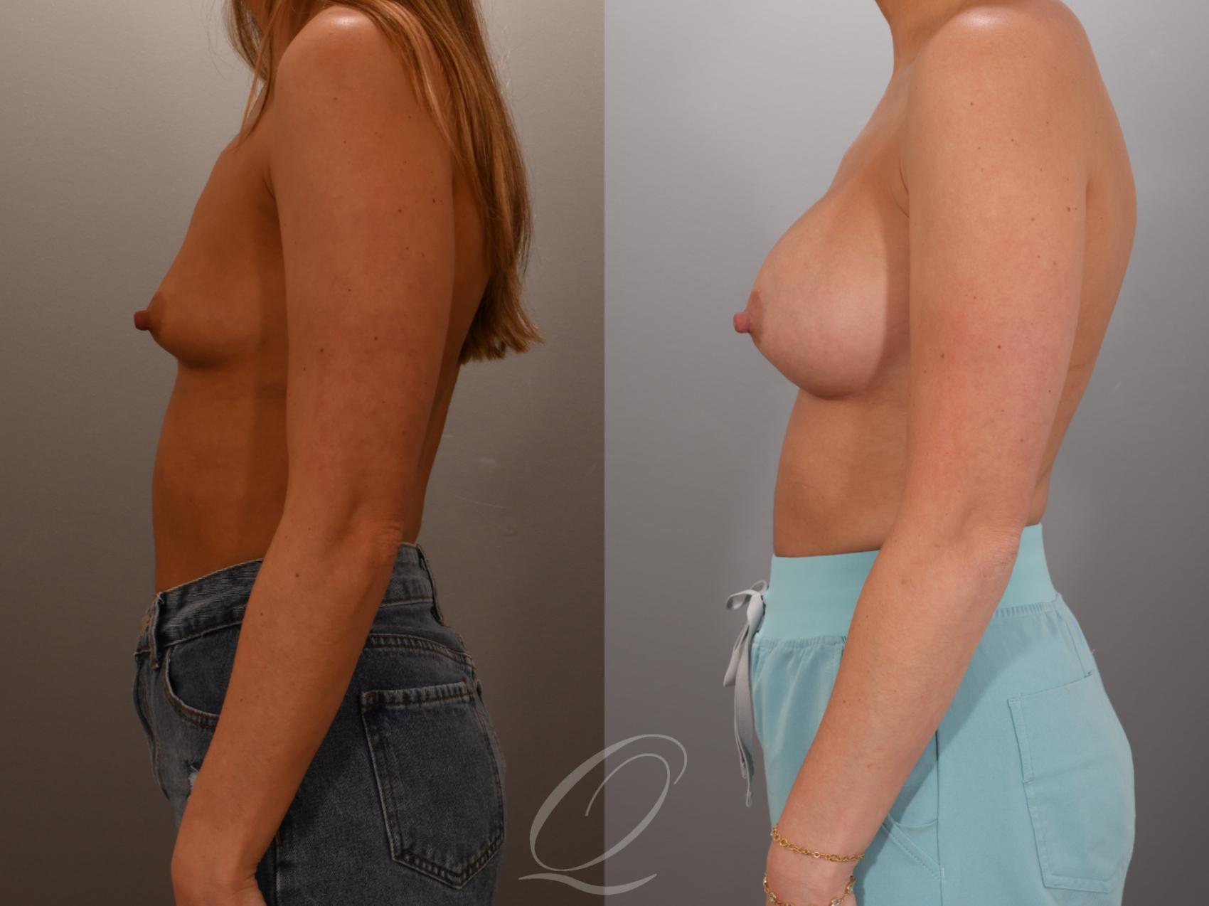 Breast Augmentation Case 1001936 Before & After Left Side | Serving Rochester, Syracuse & Buffalo, NY | Quatela Center for Plastic Surgery
