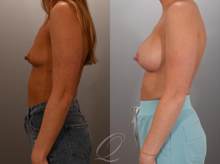 Breast Augmentation Case 1001936 Before & After Left Side | Serving Rochester, Syracuse & Buffalo, NY | Quatela Center for Plastic Surgery