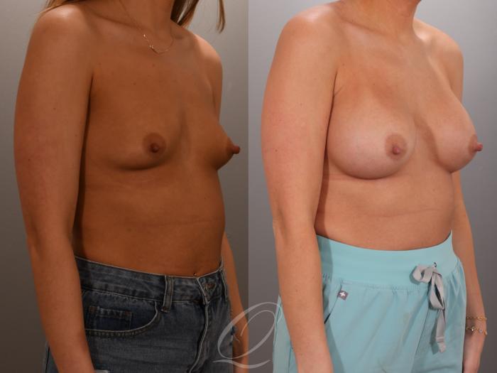 Breast Augmentation Case 1001936 Before & After Right Oblique | Serving Rochester, Syracuse & Buffalo, NY | Quatela Center for Plastic Surgery