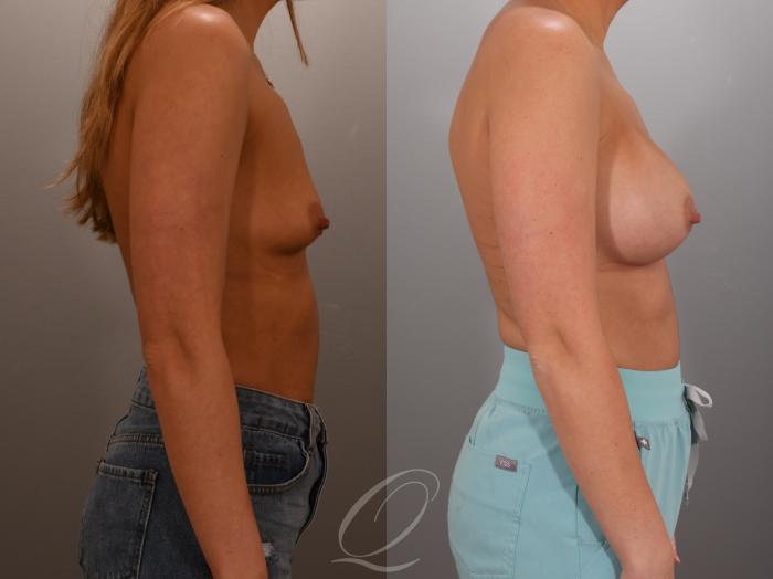 Breast Augmentation Case 1001936 Before & After Right Side | Serving Rochester, Syracuse & Buffalo, NY | Quatela Center for Plastic Surgery