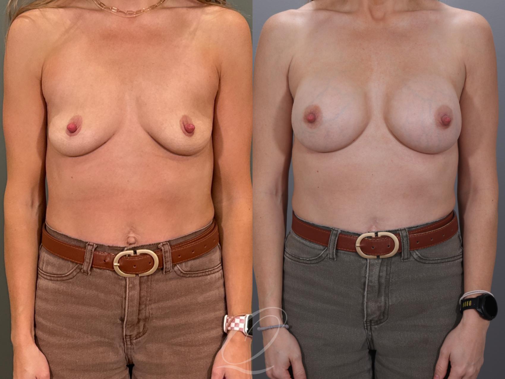 Breast Augmentation Case 1001959 Before & After Front | Serving Rochester, Syracuse & Buffalo, NY | Quatela Center for Plastic Surgery