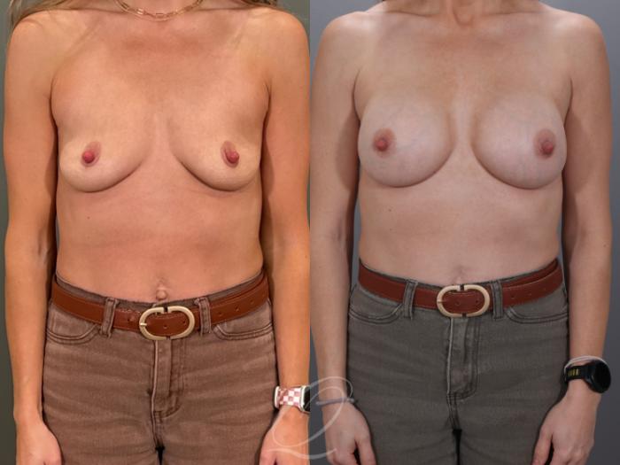 Breast Augmentation Case 1001959 Before & After Front | Serving Rochester, Syracuse & Buffalo, NY | Quatela Center for Plastic Surgery
