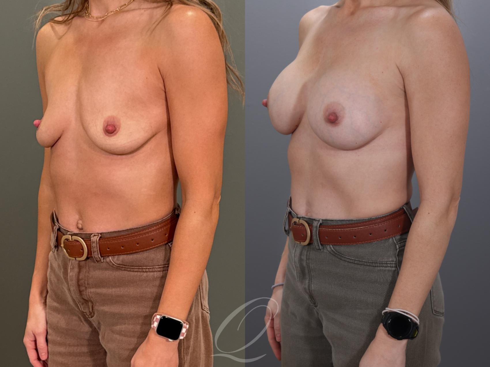 Breast Augmentation Case 1001959 Before & After Left Oblique | Serving Rochester, Syracuse & Buffalo, NY | Quatela Center for Plastic Surgery