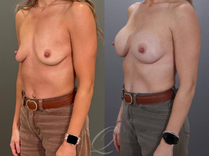 Breast Augmentation Case 1001959 Before & After Left Oblique | Serving Rochester, Syracuse & Buffalo, NY | Quatela Center for Plastic Surgery