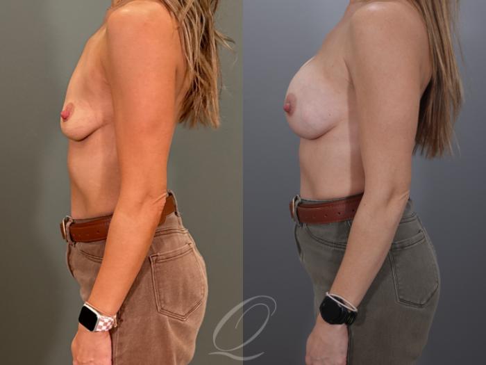 Breast Augmentation Case 1001959 Before & After Left Side | Serving Rochester, Syracuse & Buffalo, NY | Quatela Center for Plastic Surgery