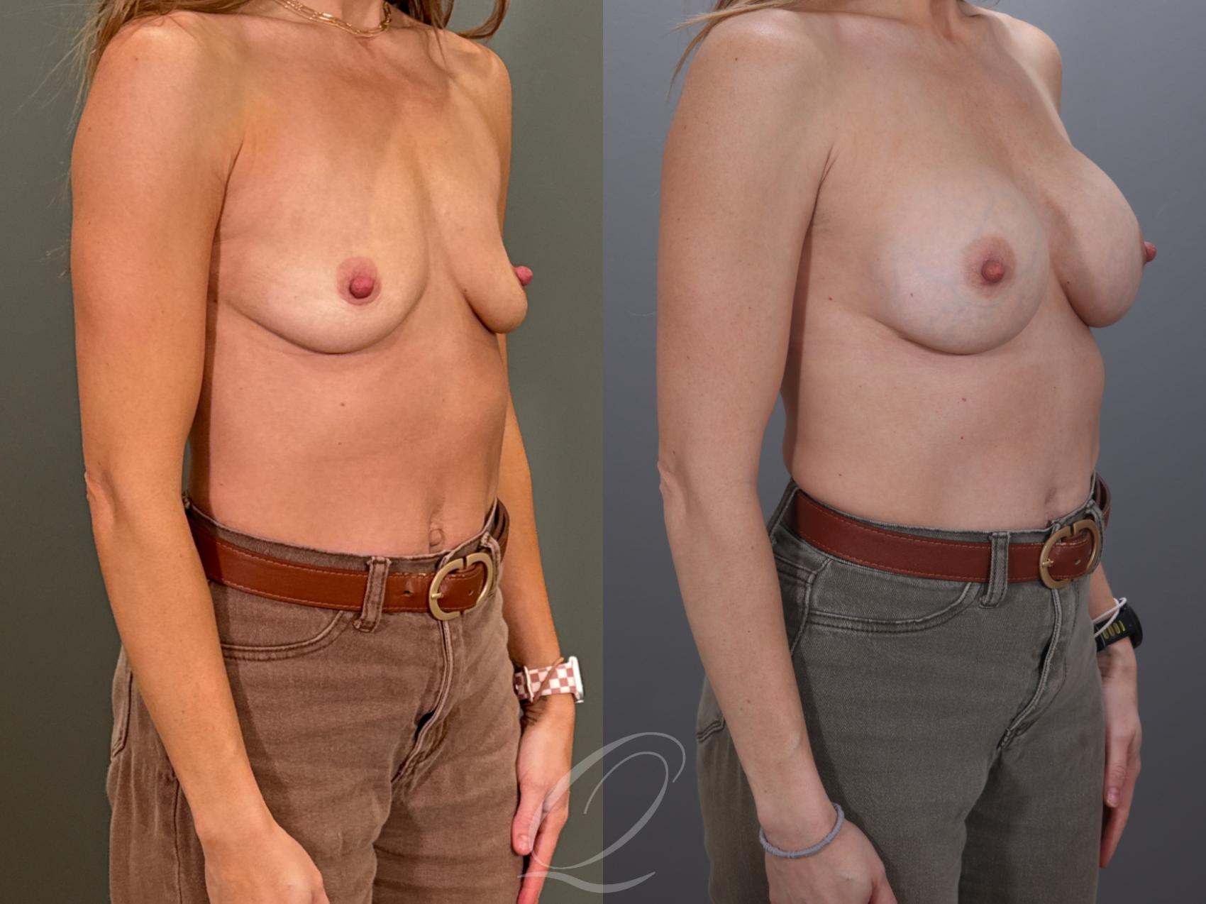 Breast Augmentation Case 1001959 Before & After Right Oblique | Serving Rochester, Syracuse & Buffalo, NY | Quatela Center for Plastic Surgery