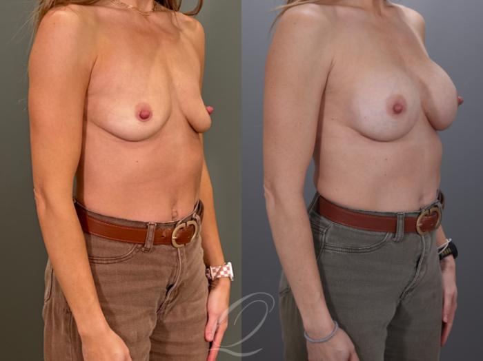 Breast Augmentation Case 1001959 Before & After Right Oblique | Serving Rochester, Syracuse & Buffalo, NY | Quatela Center for Plastic Surgery