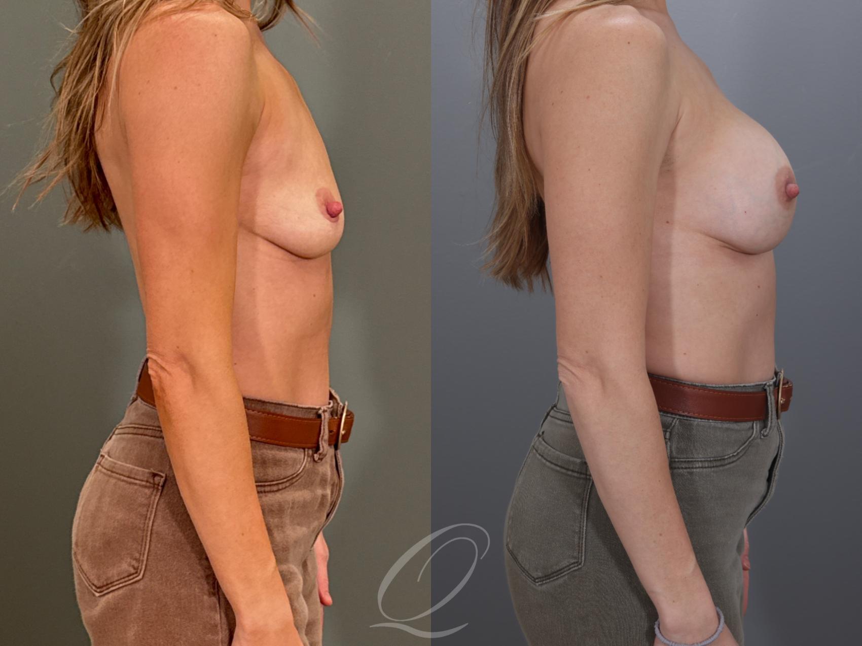 Breast Augmentation Case 1001959 Before & After Right Side | Serving Rochester, Syracuse & Buffalo, NY | Quatela Center for Plastic Surgery