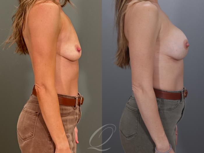 Breast Augmentation Case 1001959 Before & After Right Side | Serving Rochester, Syracuse & Buffalo, NY | Quatela Center for Plastic Surgery