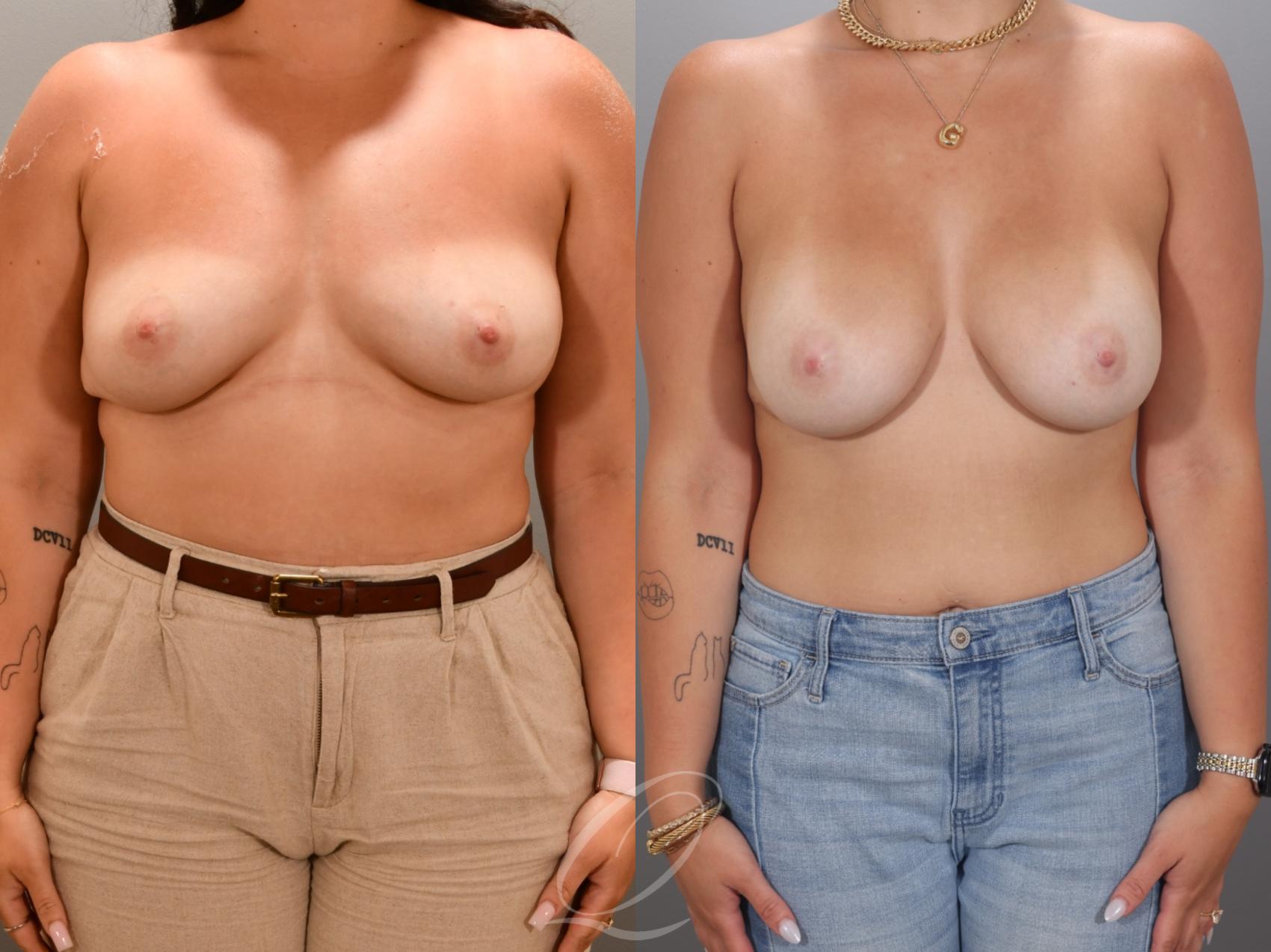 Breast Augmentation Case 1001967 Before & After Front | Serving Rochester, Syracuse & Buffalo, NY | Quatela Center for Plastic Surgery