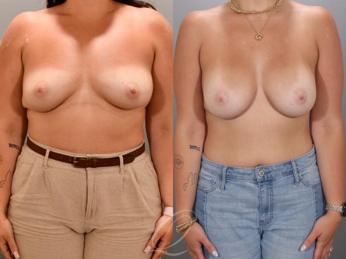 Breast Augmentation Case 1001967 Before & After Front | Serving Rochester, Syracuse & Buffalo, NY | Quatela Center for Plastic Surgery