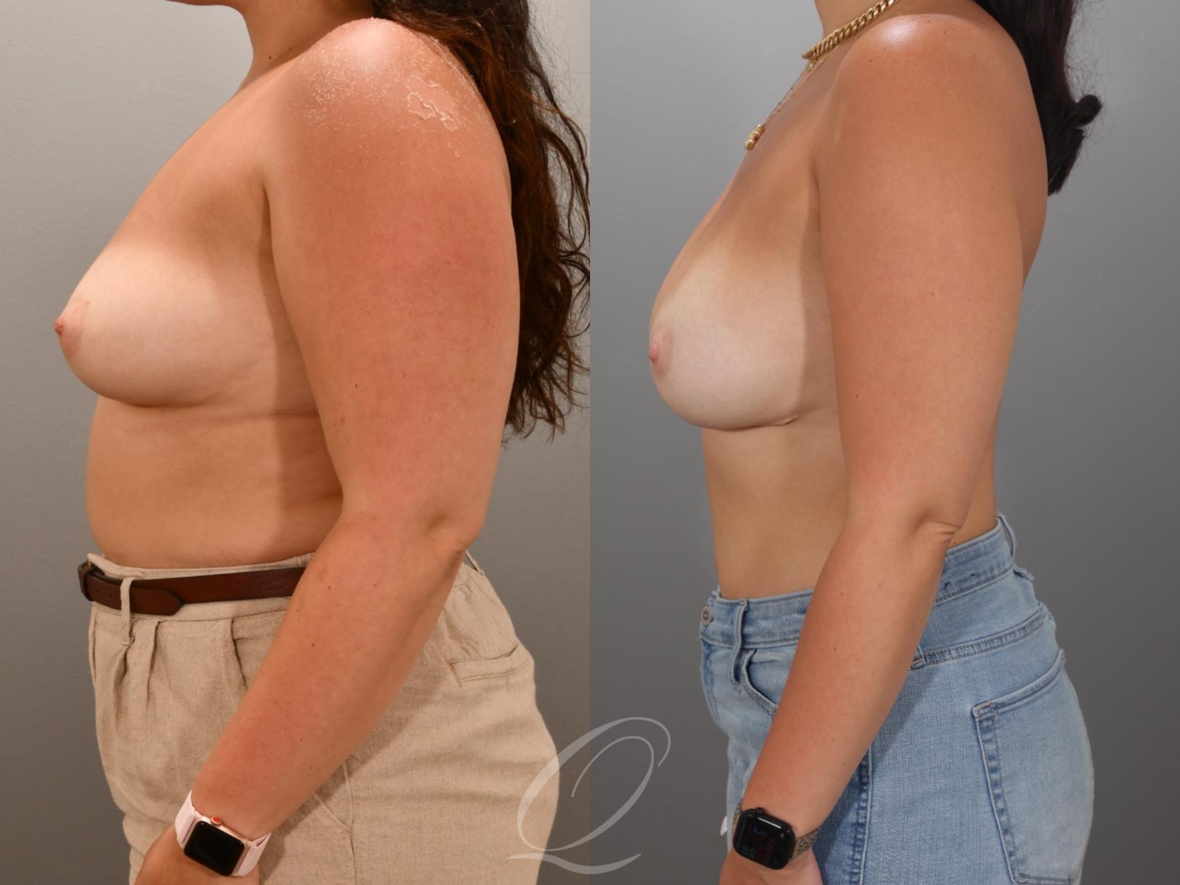 Breast Augmentation Case 1001967 Before & After Left Side | Serving Rochester, Syracuse & Buffalo, NY | Quatela Center for Plastic Surgery