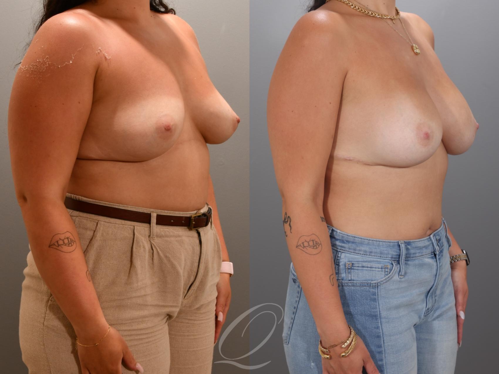 Breast Augmentation Case 1001967 Before & After Right Oblique | Serving Rochester, Syracuse & Buffalo, NY | Quatela Center for Plastic Surgery