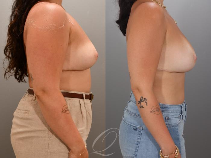 Breast Augmentation Case 1001967 Before & After Right Side | Serving Rochester, Syracuse & Buffalo, NY | Quatela Center for Plastic Surgery