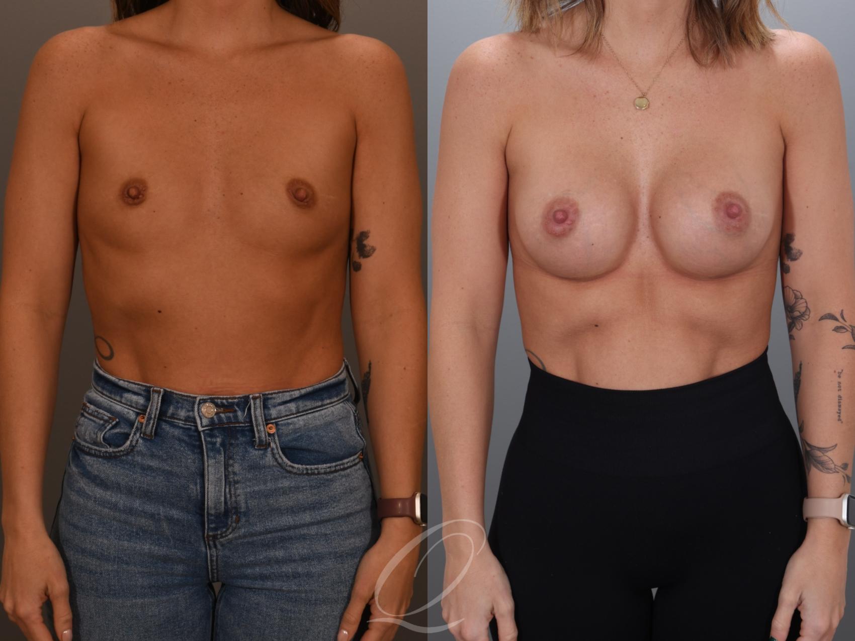 Breast Augmentation Case 1001993 Before & After Front | Serving Rochester, Syracuse & Buffalo, NY | Quatela Center for Plastic Surgery