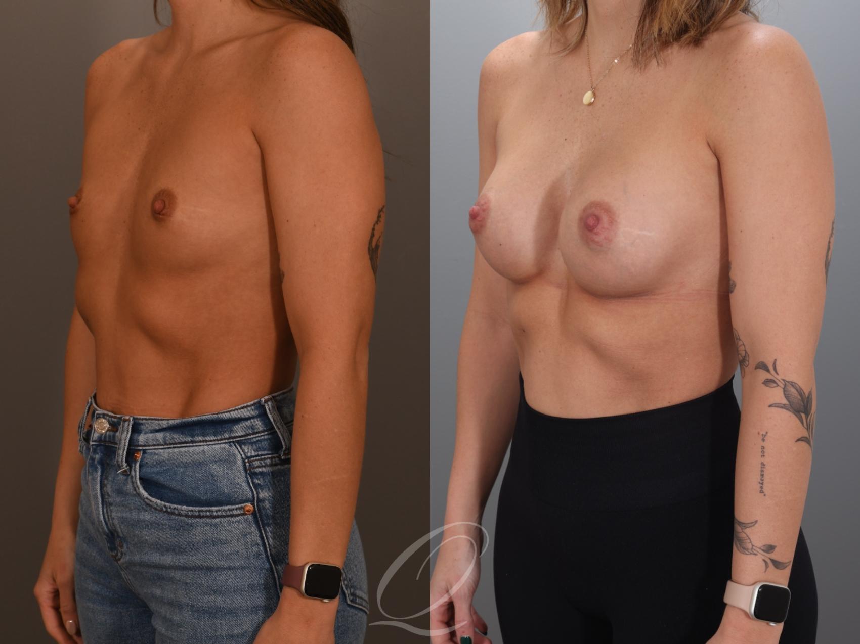 Breast Augmentation Case 1001993 Before & After Left Oblique | Serving Rochester, Syracuse & Buffalo, NY | Quatela Center for Plastic Surgery