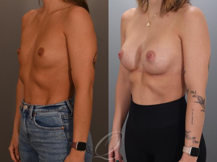 Breast Augmentation Case 1001993 Before & After Left Oblique | Serving Rochester, Syracuse & Buffalo, NY | Quatela Center for Plastic Surgery