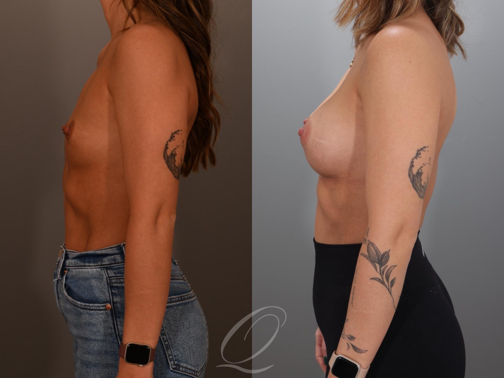 Breast Augmentation Case 1001993 Before & After Left Side | Serving Rochester, Syracuse & Buffalo, NY | Quatela Center for Plastic Surgery