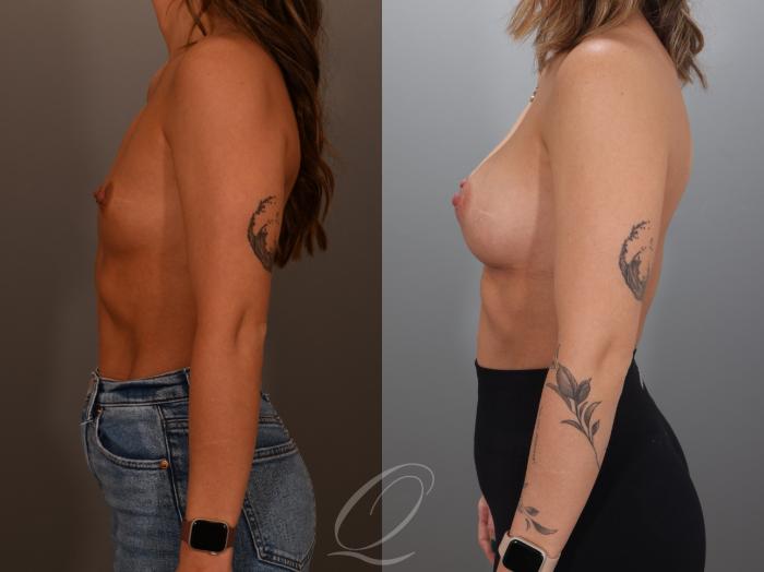 Breast Augmentation Case 1001993 Before & After Left Side | Serving Rochester, Syracuse & Buffalo, NY | Quatela Center for Plastic Surgery