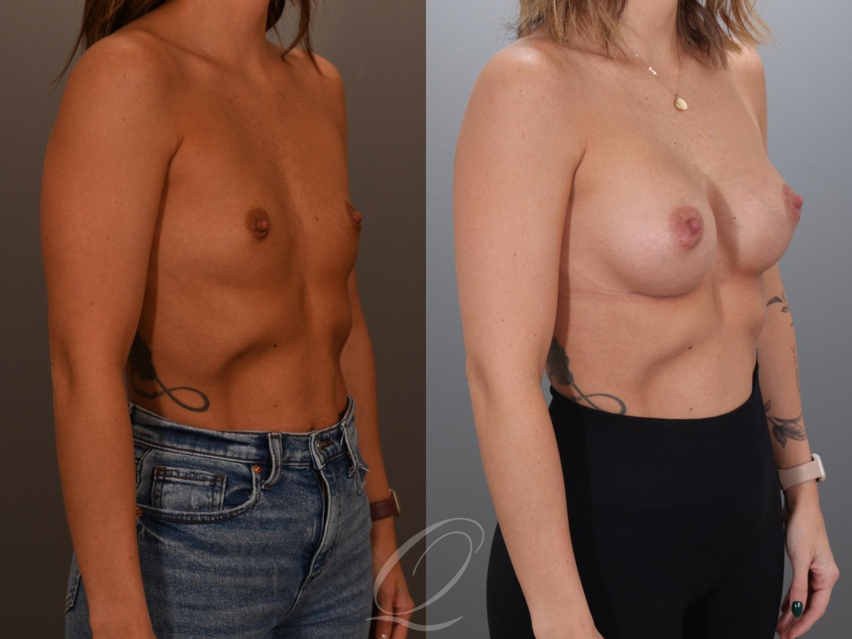 Breast Augmentation Case 1001993 Before & After Right Oblique | Serving Rochester, Syracuse & Buffalo, NY | Quatela Center for Plastic Surgery