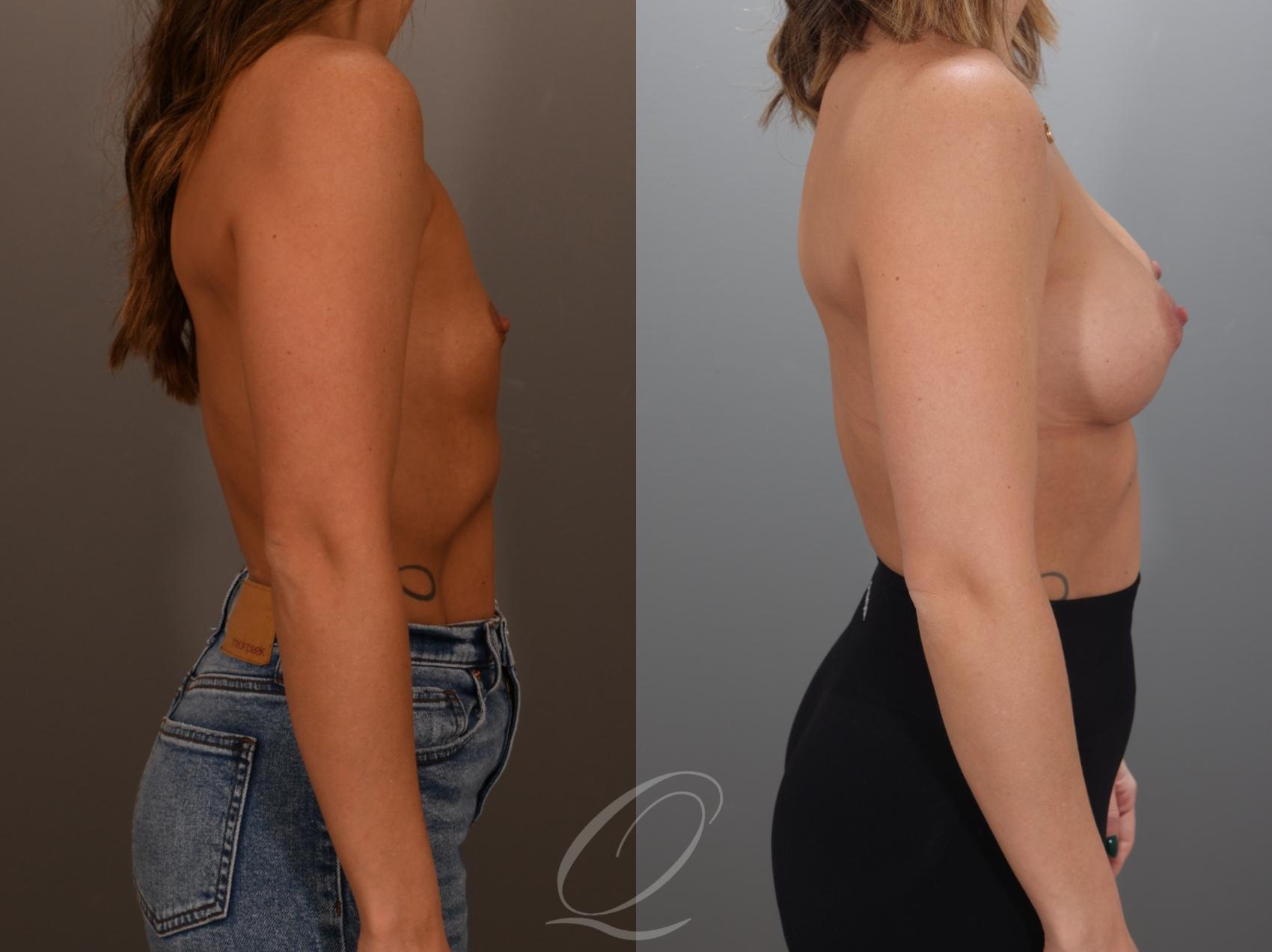 Breast Augmentation Case 1001993 Before & After Right Side | Serving Rochester, Syracuse & Buffalo, NY | Quatela Center for Plastic Surgery