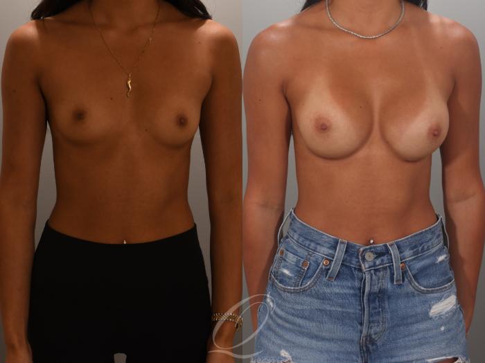 Breast Augmentation Case 1001995 Before & After Front | Serving Rochester, Syracuse & Buffalo, NY | Quatela Center for Plastic Surgery
