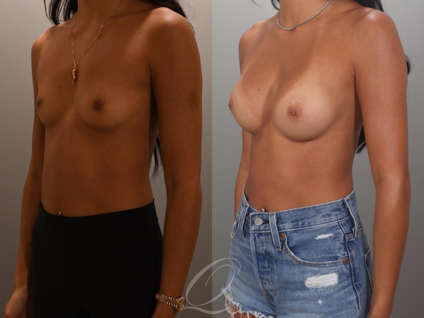 Breast Augmentation Case 1001995 Before & After Left Oblique | Serving Rochester, Syracuse & Buffalo, NY | Quatela Center for Plastic Surgery