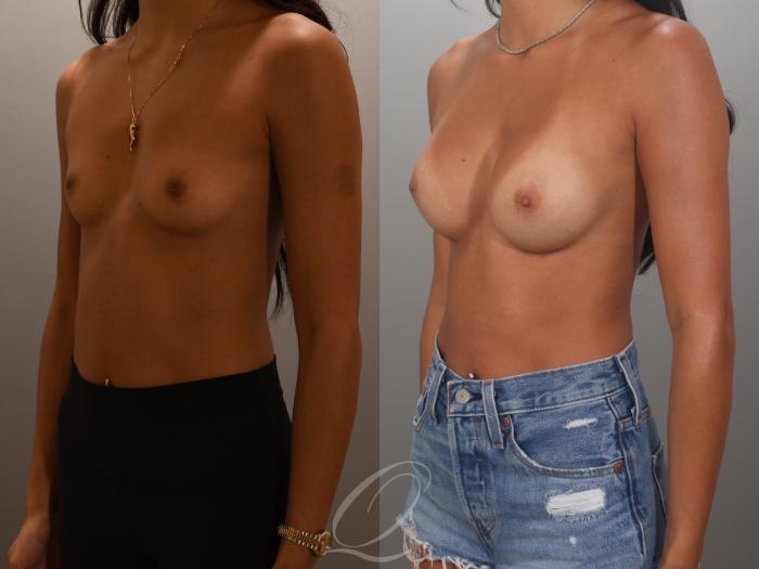 Breast Augmentation Case 1001995 Before & After Left Oblique | Serving Rochester, Syracuse & Buffalo, NY | Quatela Center for Plastic Surgery