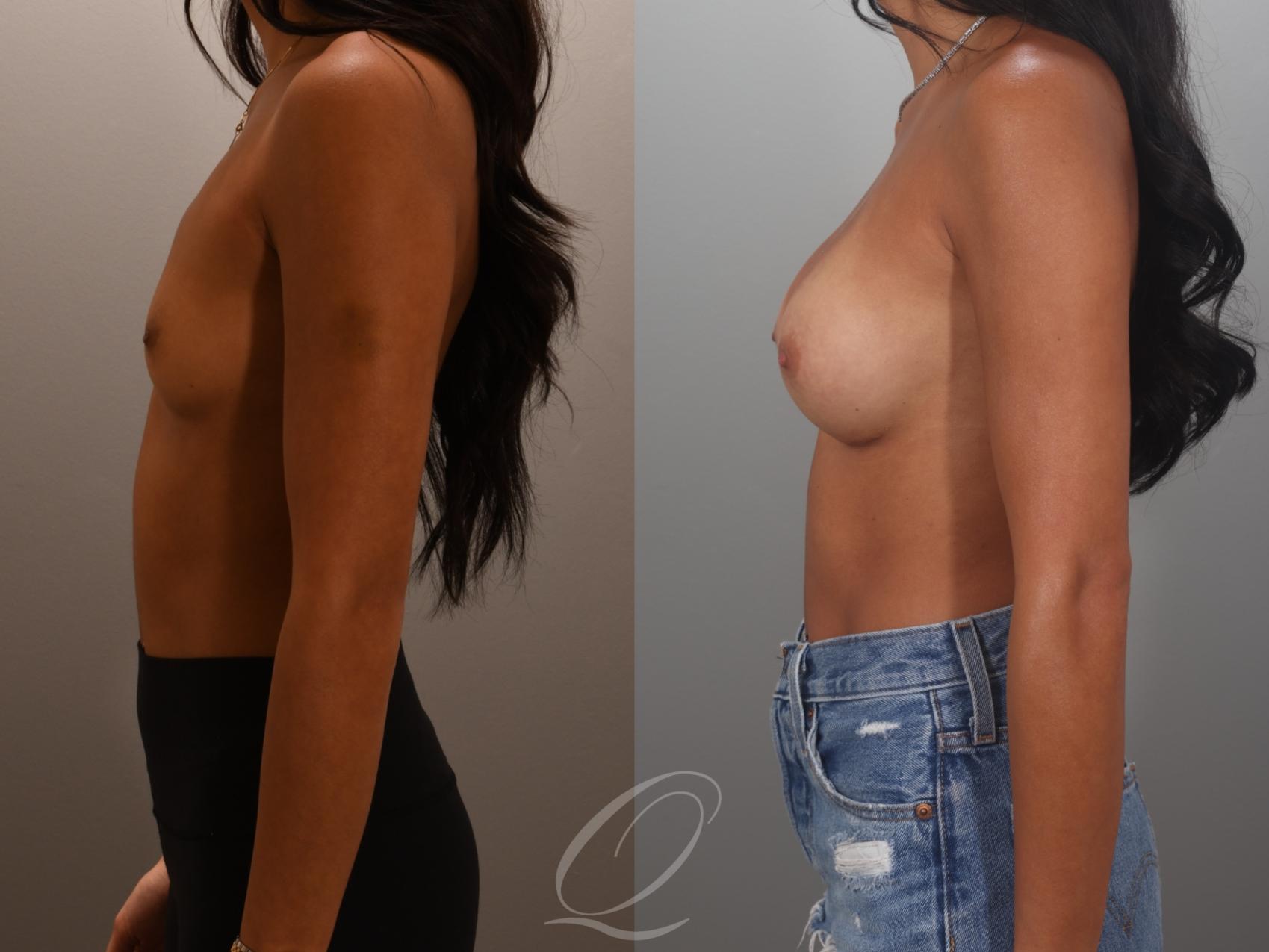 Breast Augmentation Case 1001995 Before & After Left Side | Serving Rochester, Syracuse & Buffalo, NY | Quatela Center for Plastic Surgery