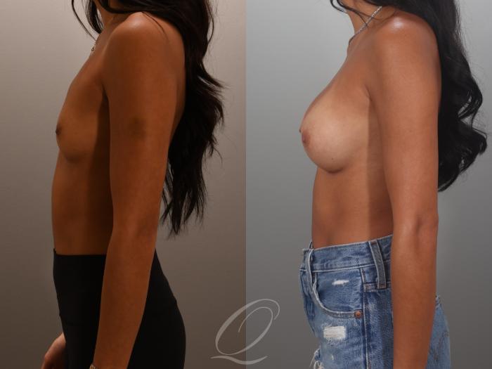 Breast Augmentation Case 1001995 Before & After Left Side | Serving Rochester, Syracuse & Buffalo, NY | Quatela Center for Plastic Surgery