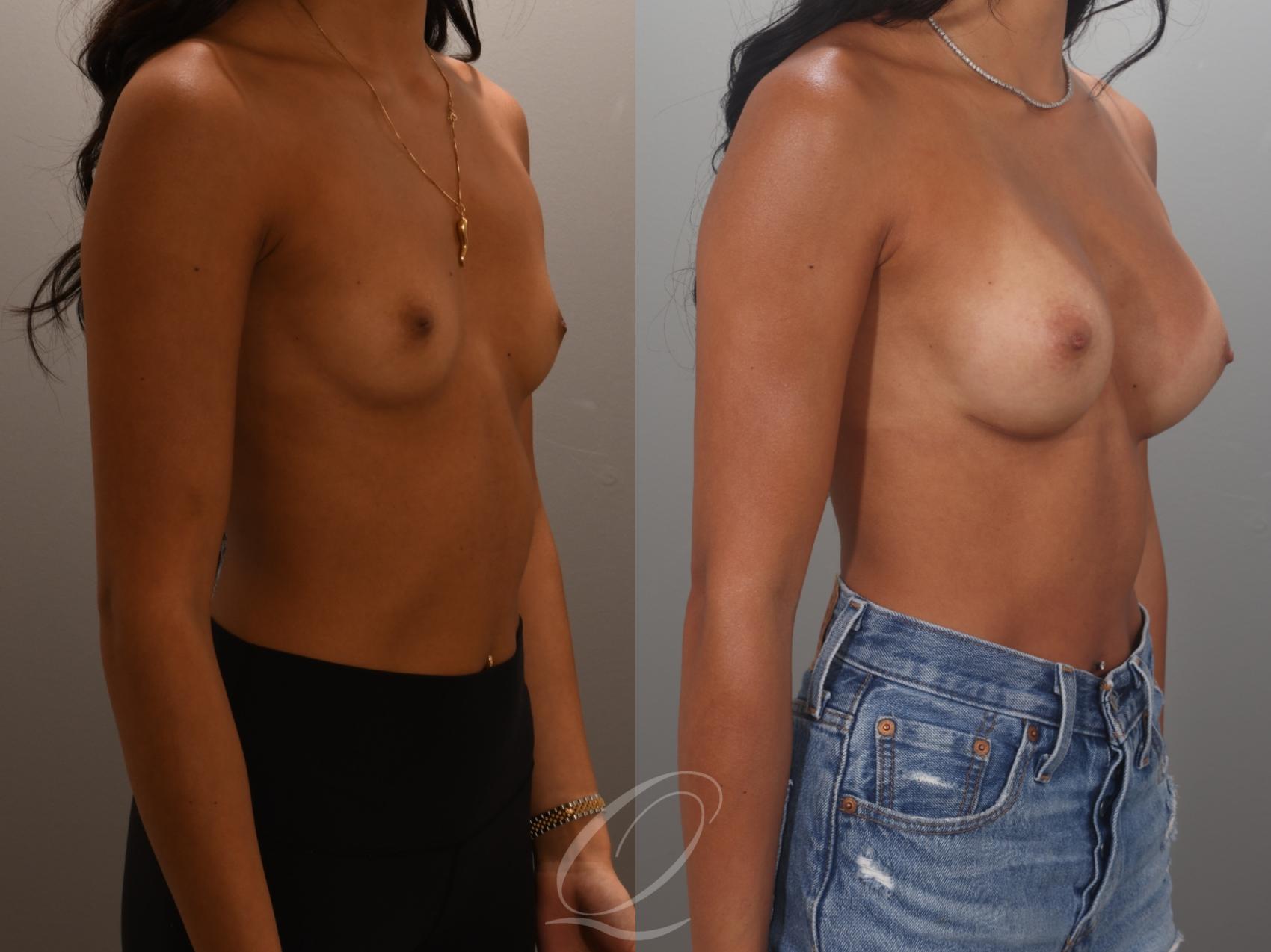 Breast Augmentation Case 1001995 Before & After Right Oblique | Serving Rochester, Syracuse & Buffalo, NY | Quatela Center for Plastic Surgery