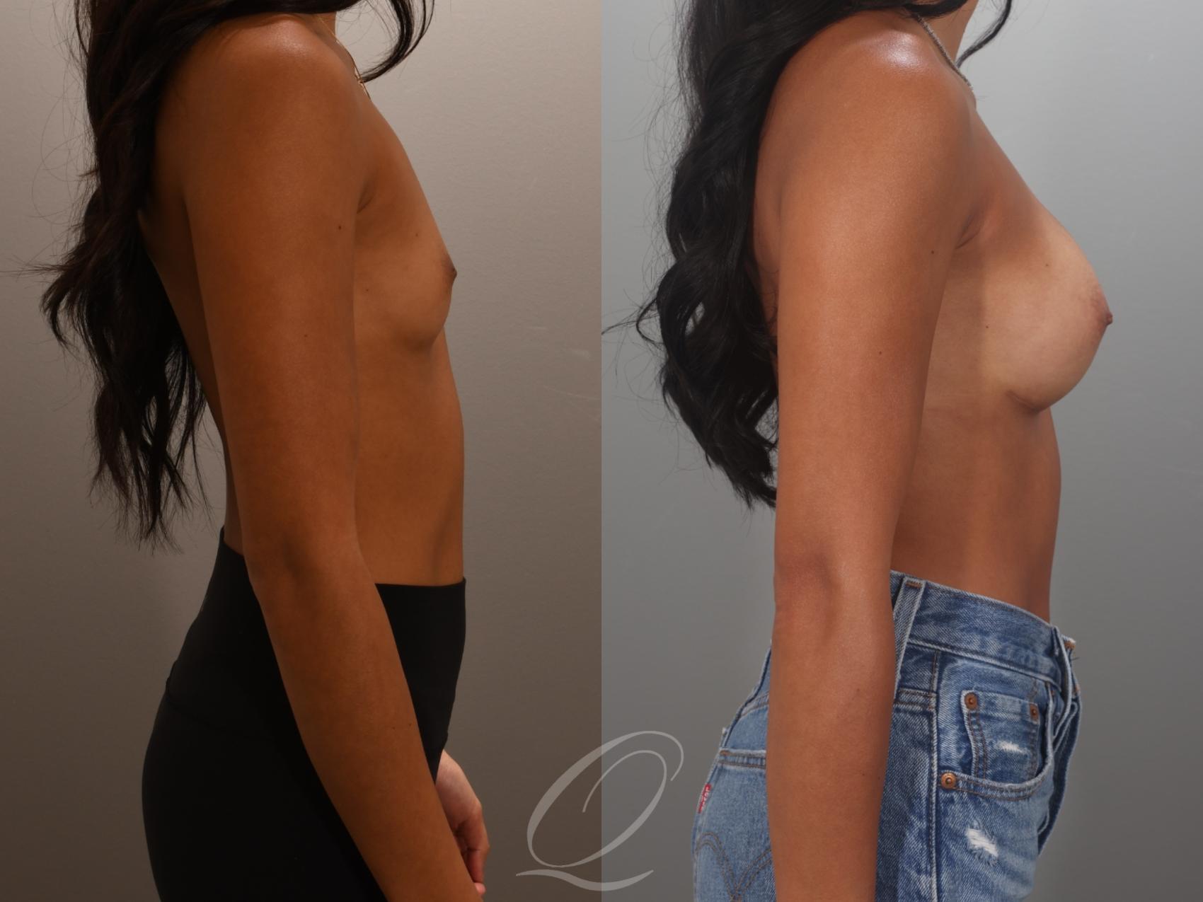 Breast Augmentation Case 1001995 Before & After Right Side | Serving Rochester, Syracuse & Buffalo, NY | Quatela Center for Plastic Surgery