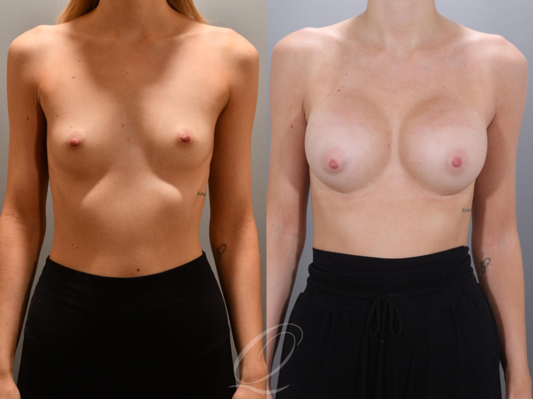 Breast Augmentation Case 1002000 Before & After Front | Serving Rochester, Syracuse & Buffalo, NY | Quatela Center for Plastic Surgery