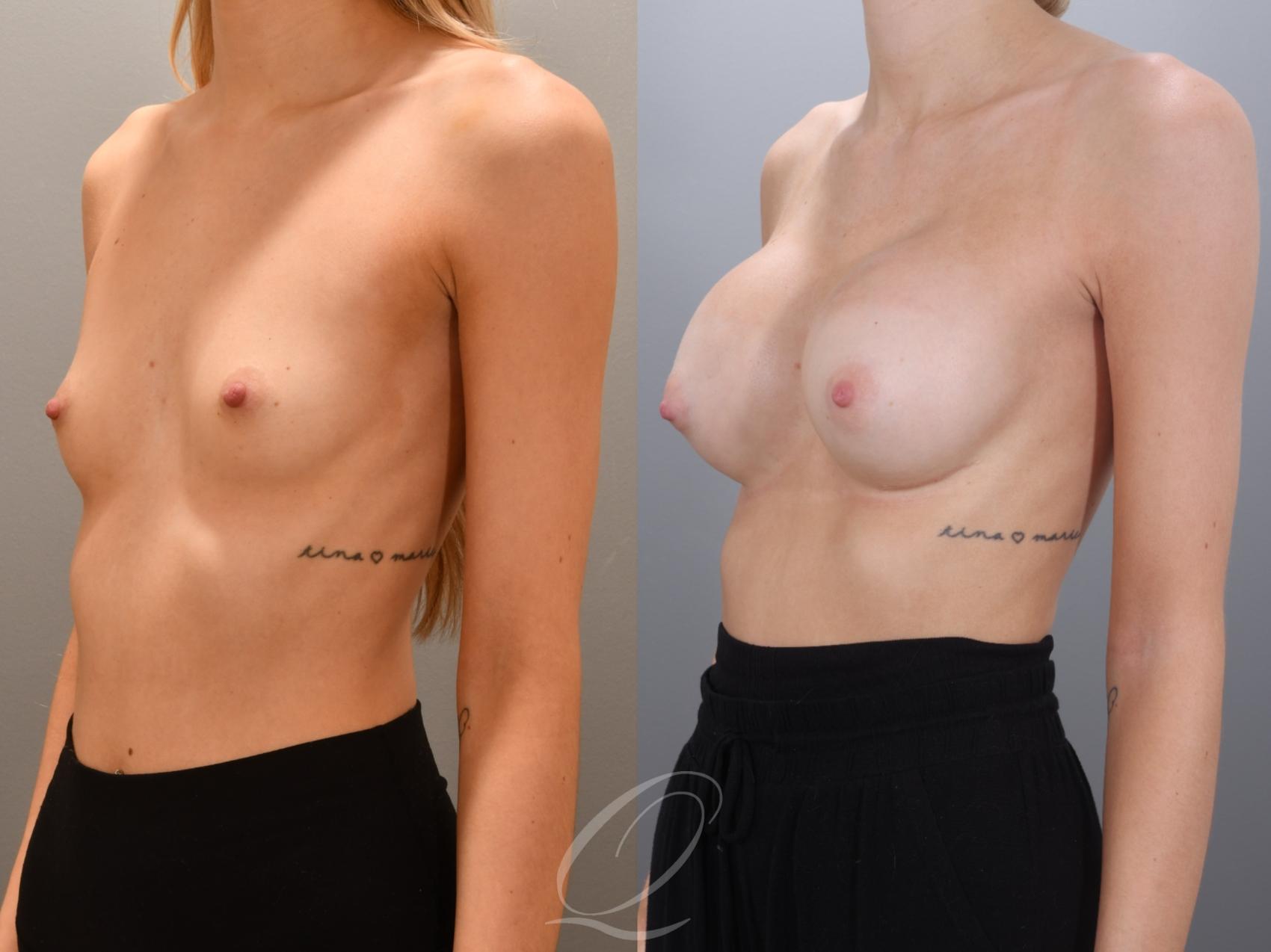 Breast Augmentation Case 1002000 Before & After Left Oblique | Serving Rochester, Syracuse & Buffalo, NY | Quatela Center for Plastic Surgery