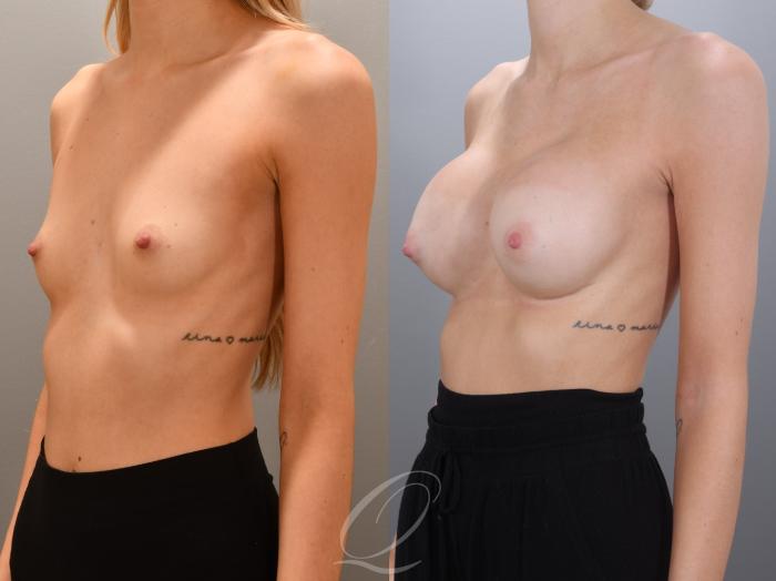 Breast Augmentation Case 1002000 Before & After Left Oblique | Serving Rochester, Syracuse & Buffalo, NY | Quatela Center for Plastic Surgery