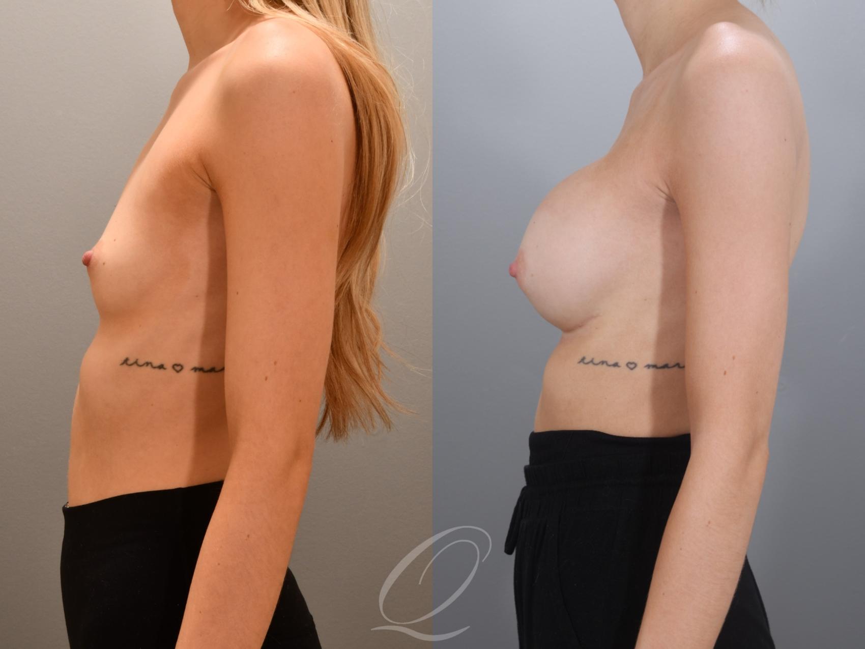 Breast Augmentation Case 1002000 Before & After Left Side | Serving Rochester, Syracuse & Buffalo, NY | Quatela Center for Plastic Surgery