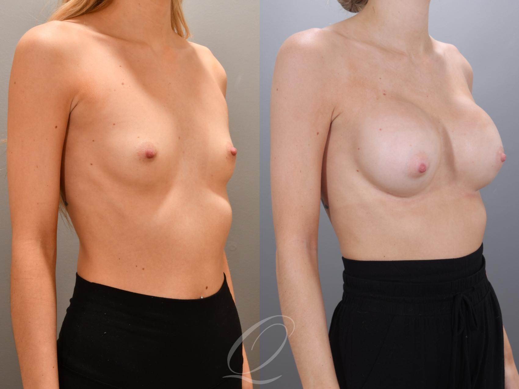 Breast Augmentation Case 1002000 Before & After Right Oblique | Serving Rochester, Syracuse & Buffalo, NY | Quatela Center for Plastic Surgery