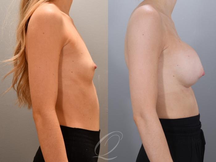 Breast Augmentation Case 1002000 Before & After Right Side | Serving Rochester, Syracuse & Buffalo, NY | Quatela Center for Plastic Surgery