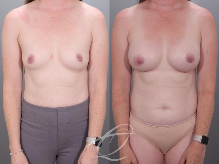 Breast Augmentation Case 1002028 Before & After Front | Serving Rochester, Syracuse & Buffalo, NY | Quatela Center for Plastic Surgery