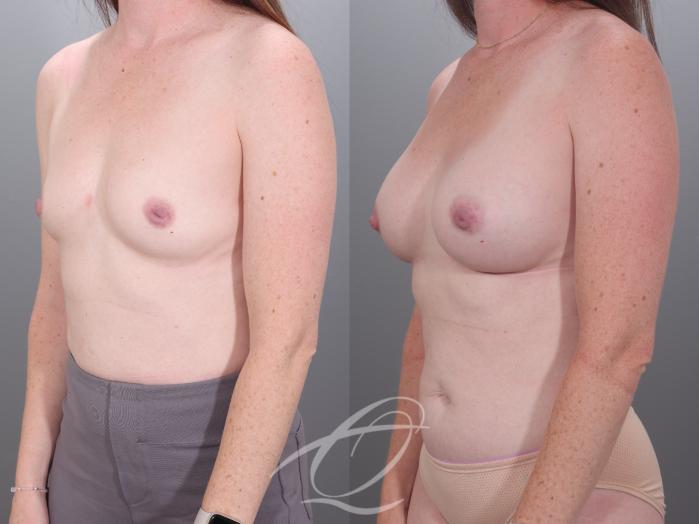 Breast Augmentation Case 1002028 Before & After Left Oblique | Serving Rochester, Syracuse & Buffalo, NY | Quatela Center for Plastic Surgery
