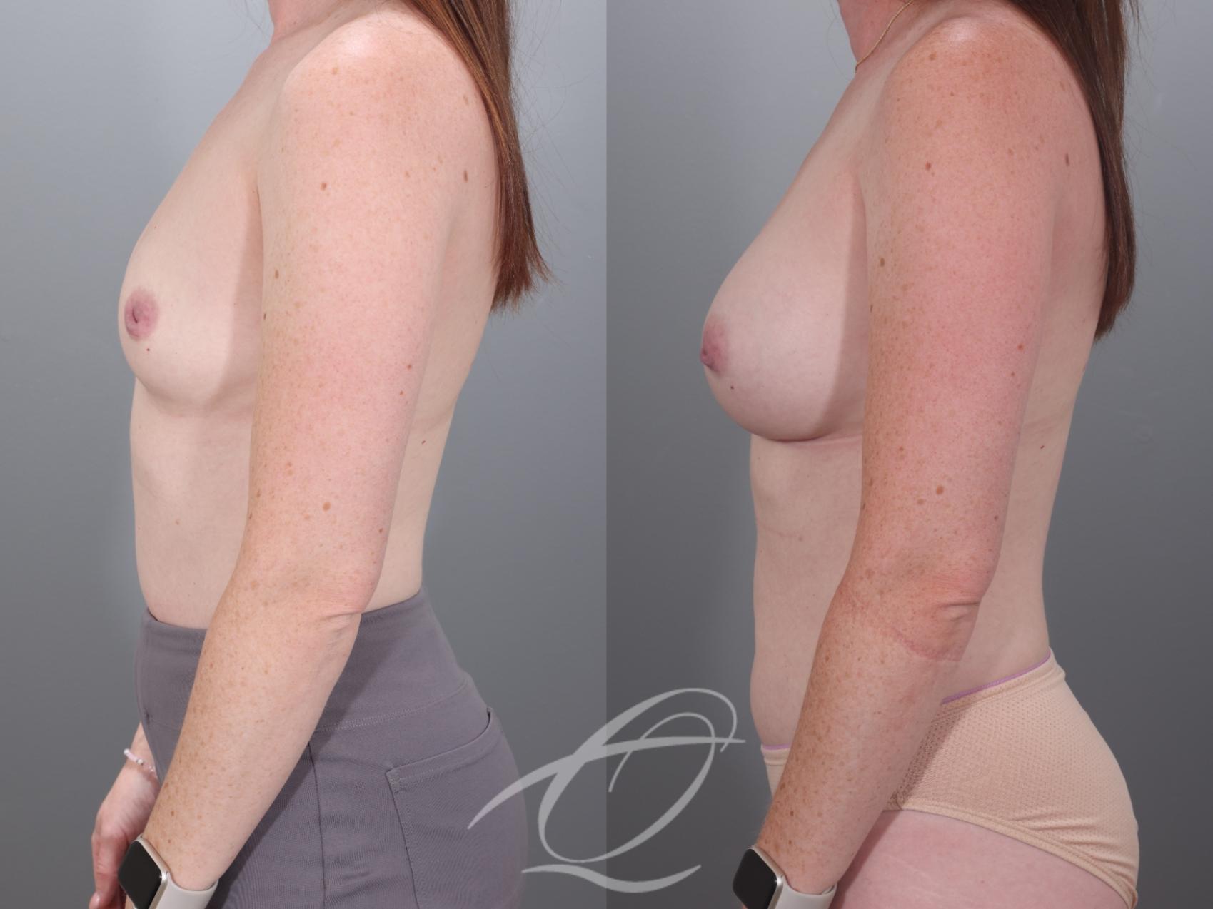 Breast Augmentation Case 1002028 Before & After Left Side | Serving Rochester, Syracuse & Buffalo, NY | Quatela Center for Plastic Surgery