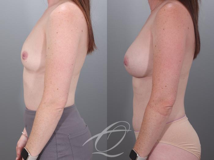 Breast Augmentation Case 1002028 Before & After Left Side | Serving Rochester, Syracuse & Buffalo, NY | Quatela Center for Plastic Surgery